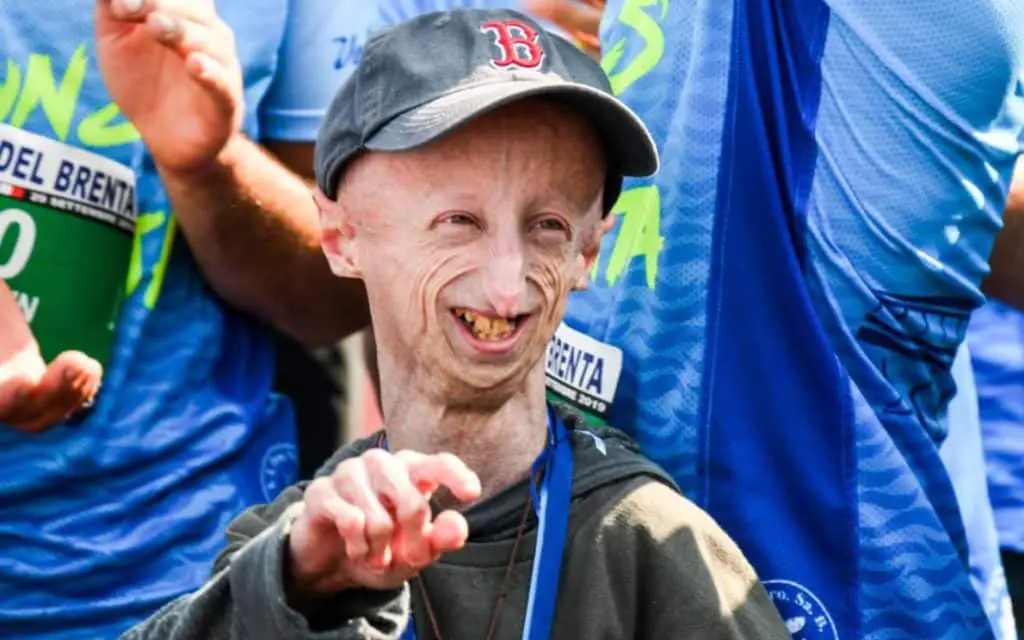 sammy basso progeria