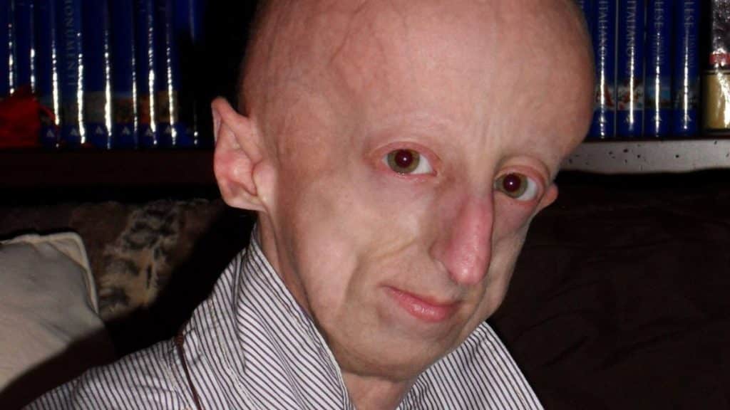 sammy basso progeria