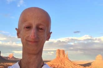 sammy basso progeria